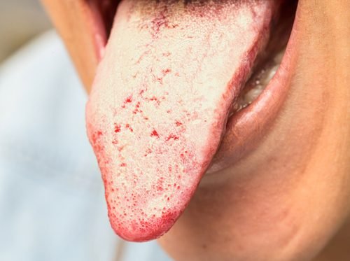 Traitement de la candidose