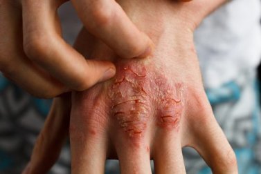 Traitement du psoriasis