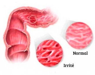 4 conseils pour soulager le côlon irritable
