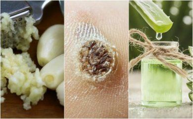 5 remèdes naturels pour traiter les verrues