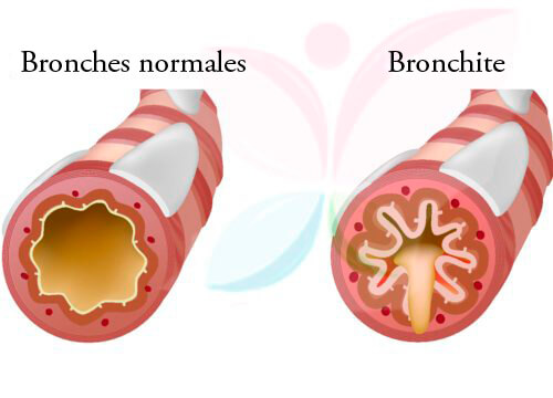 5 remèdes efficaces pour traiter la bronchite