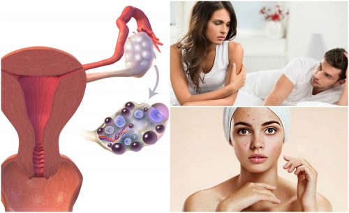 7 symptômes du syndrome des ovaires polykystiques que vous ne devez pas négliger