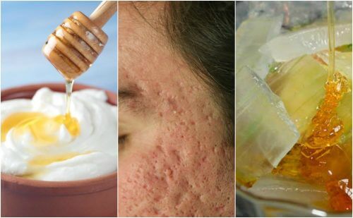 L'acné a laissé des marques sur votre visage ? Atténuez-les avec ces 5 masques naturels