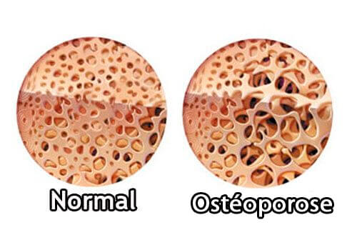 Ostéoporose et la maladie de Crohn.