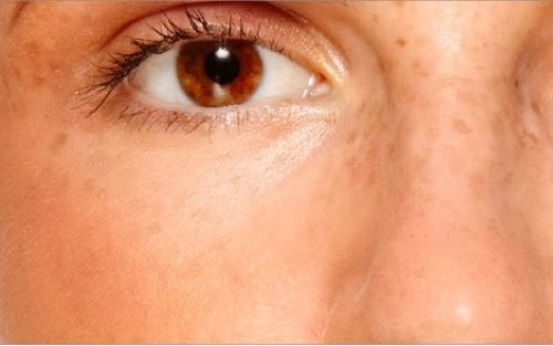taches sur la peau en raison du syndrome des ovaires polykystiques