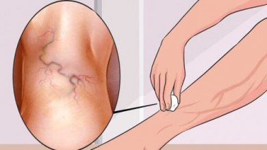 8 exercices pour traiter les varices