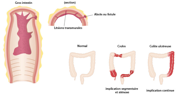 La maladie de Crohn.