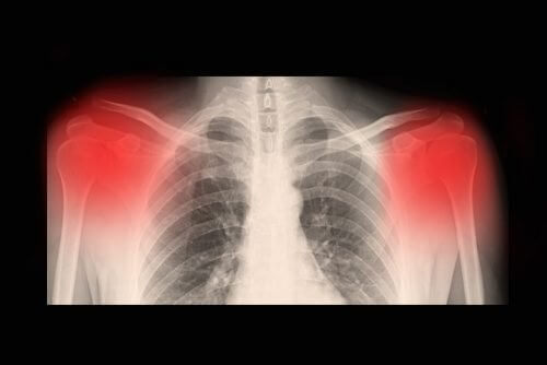 Qu’est-ce que l’arthrose ? Qu’est-ce que l’arthrose ?