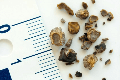 6 aliments qui peuvent causer des calculs rénaux