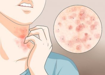 Remèdes maison pour soulager la gale d'une manière simple