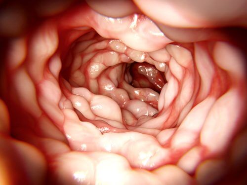 Le traitement de la maladie de Crohn