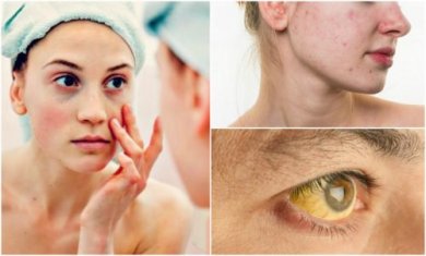 7 symptômes qui affectent votre visage lorsque vous souffrez de carences nutritionnelles