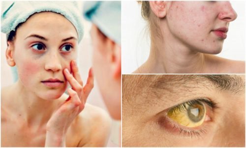 7 symptômes qui affectent votre visage lorsque vous souffrez de carences nutritionnelles