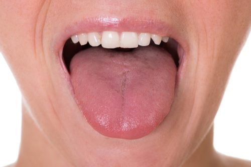 Les 5 premiers symptômes possibles du cancer de la langue
