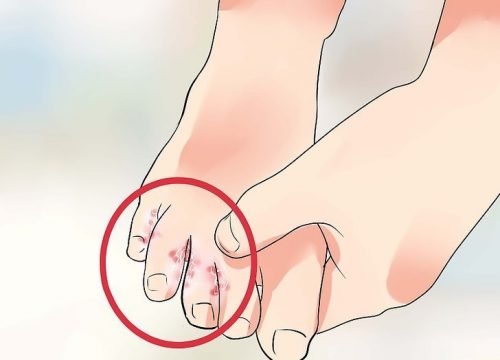 7 remèdes naturels pour traiter le pied d'athlète