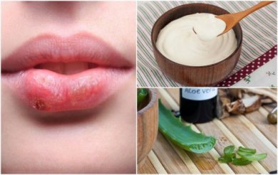 7 traitements d'origine naturelle pour combattre l'herpès labial
