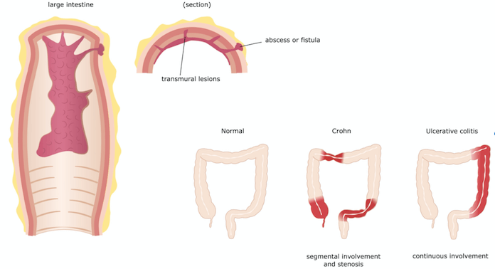 la maladie de Crohn