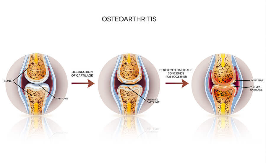 Qu est ce Que L arthrose Am liore Ta Sant qu-est-ce-que-l-arthrose-am-liore-ta-sant