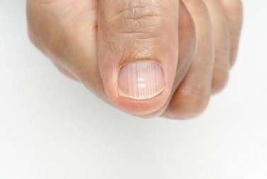 Pourquoi ai-je des lignes sur les ongles et comment les éliminer ?