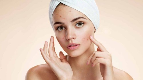 Secrets de beauté contre l'acné