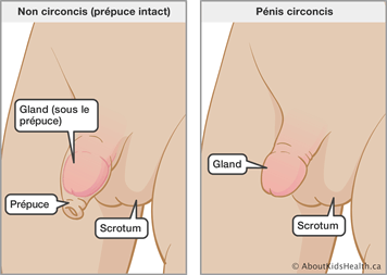 Le phimosis