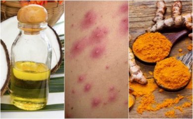 5 remèdes contre l'infection des follicules pileux