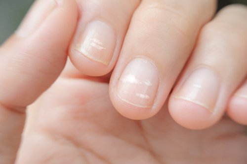 un déficit en zinc peut provoquer des lignes sur les ongles