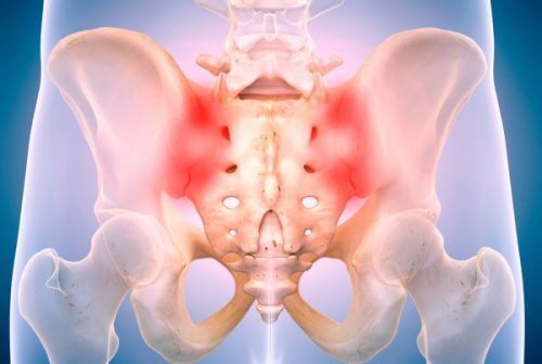 Douleur du sacrum iliaque : quand la position assise est insupportable