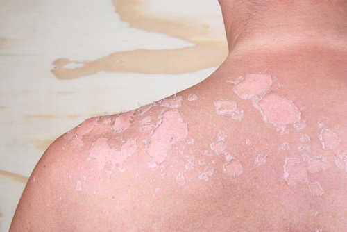 Appliquer du gel d'aloe vera.