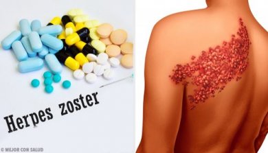 Le zona, causes et symptômes de la maladie