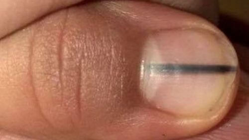 Une ligne noire sur vos ongles pourrait-elle être un signe de cancer ?