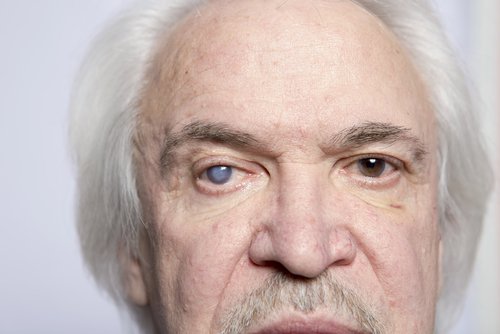 le glaucome peut survenir avec la prise de médicaments pour traiter le lupus