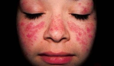 Traitement du lupus érythémateux disséminé (LED)