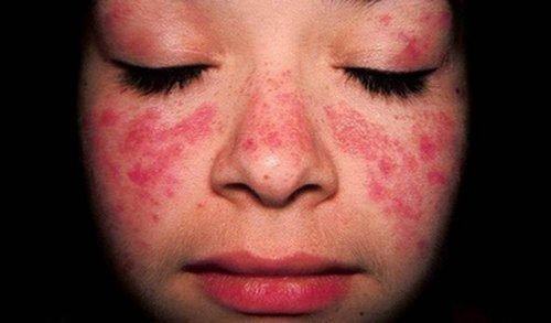 Traitement du lupus érythémateux disséminé (LED)