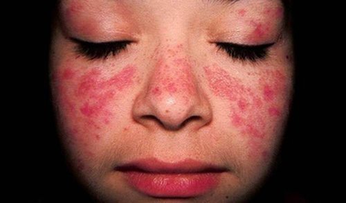 Journ e Mondiale Du Lupus La Maladie Des Ailes De Papillon Am liore journ-e-mondiale-du-lupus-la-maladie-des-ailes-de-papillon-am-liore