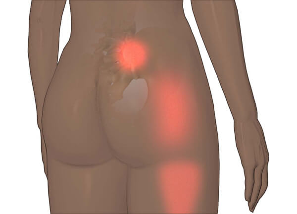 La douleur du sacrum iliaque.