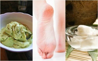 Avez-vous les talons crevassés ? Soulagez-les avec ces 5 remèdes maison