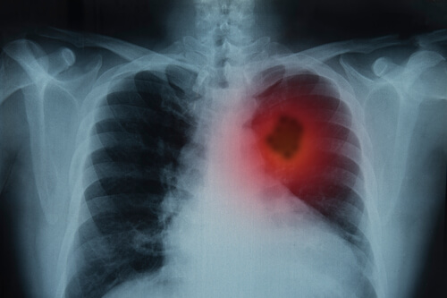 Le cancer du poumon.