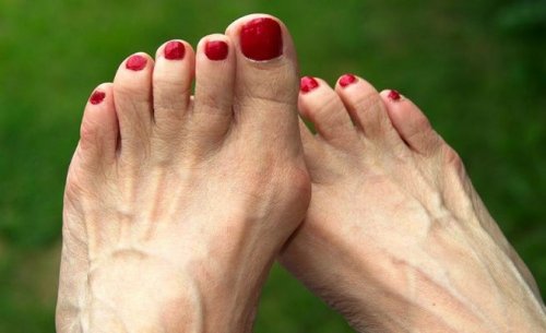 Hallux valgus