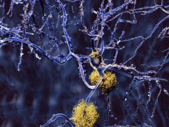 Les types de démences qui ne sont pas Alzheimer