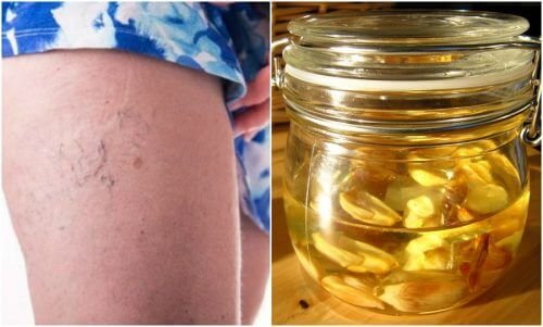 Un onguent maison contre les araignées vasculaires
