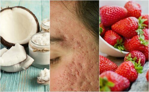 Comment atténuer les cicatrices d'acné avec 5 traitements maison