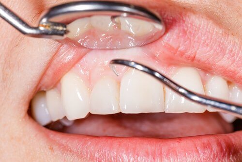 dents sensibles