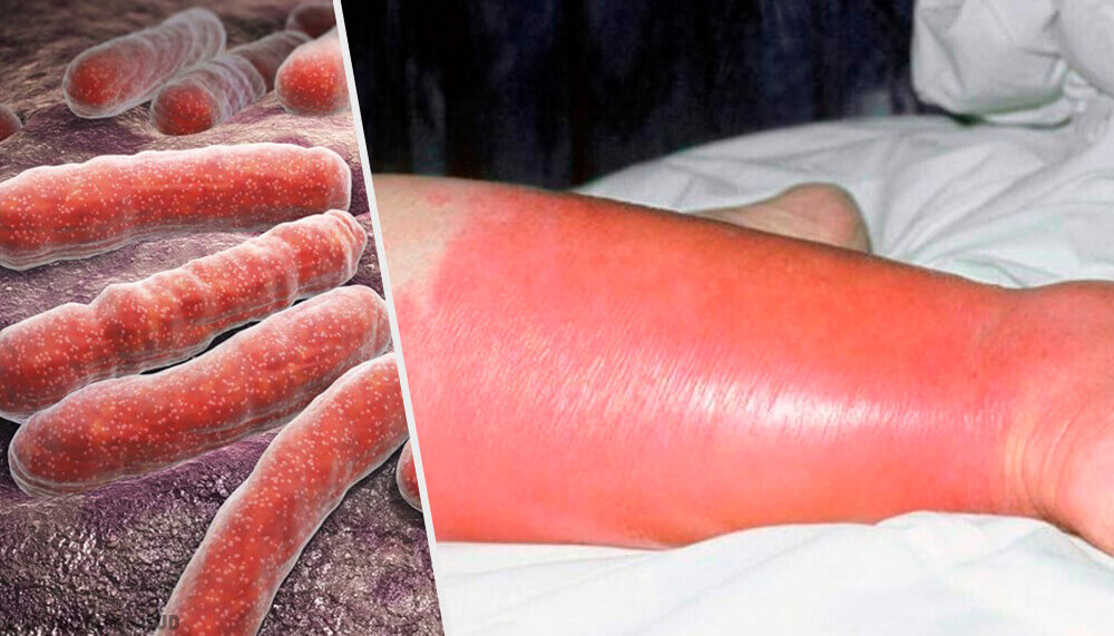 Qu'est-ce que l'érysipèle ?