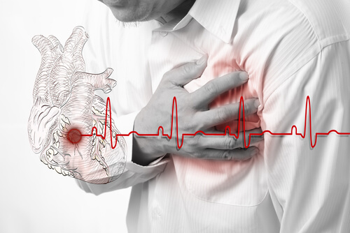 L’infarctus aigu du myocarde