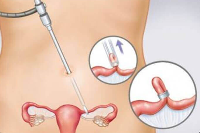 Méthodes contraceptives permanentes.