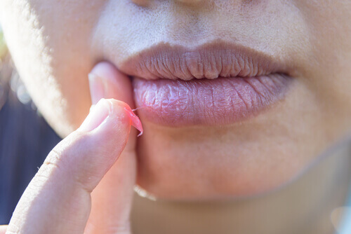 Causes des gerçures sur les lèvres.