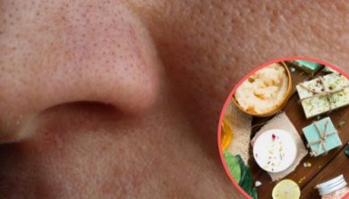 8 remèdes maison contre les pores dilatés