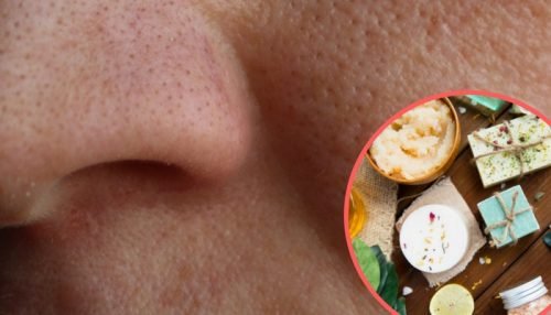 Remèdes contre les pores dilatés