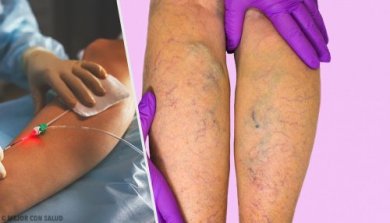 Traitements contre les varices